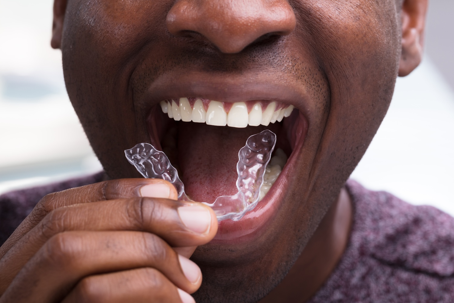 Invisalign aligners, dental hygiene, orthodontic treatment, Gastonia Family Dentistry, clear aligners, aligner care tips, healthy smile, Invisalign cleaning, orthodontic care
