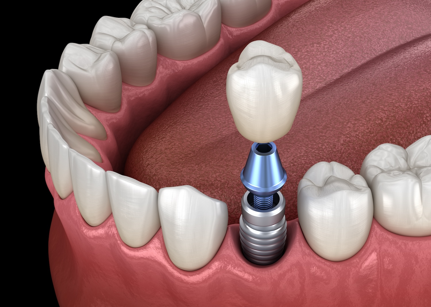 dental implants vs dentures, dental implants, dentures, tooth replacement options, Gastonia dentist, oral health solutions, implant-supported dentures